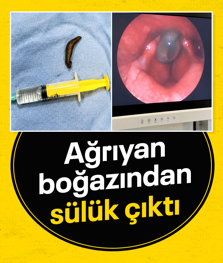 Çorum'da şiddetli boğaz ağrısının nedeni sülük çıktı